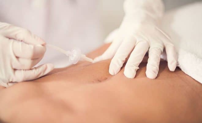 carboxiterapia em estrias carboxiterapia em estrias