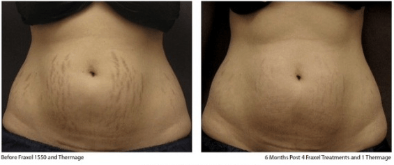 carboxiterapia estetica carboxiterapia estetica