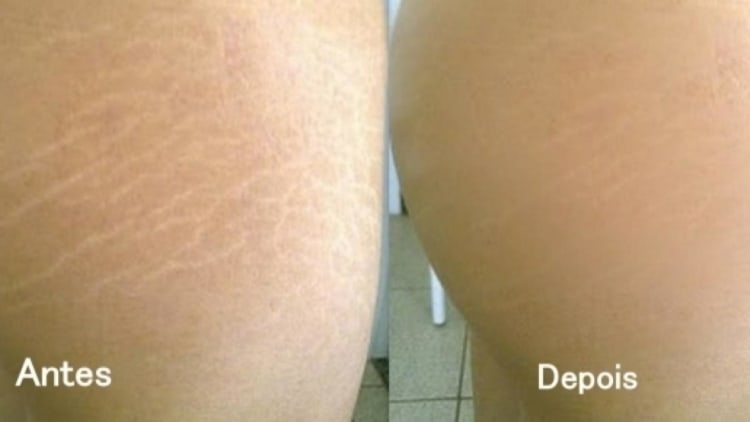 ideias de carboxiterapia para estrias antes e depois ideias de carboxiterapia para estrias antes e depois