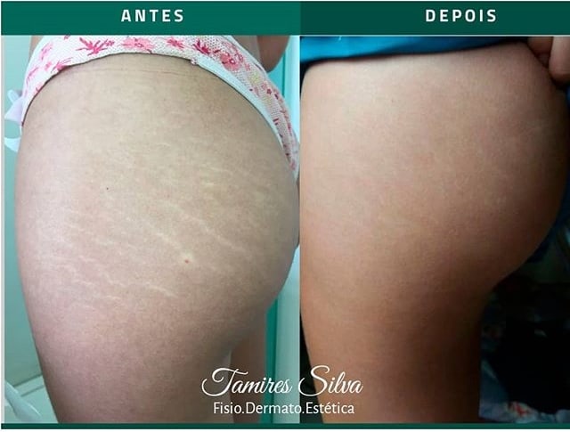 tratamento para amenizar estrias no bumbum tratamento para amenizar estrias no bumbum