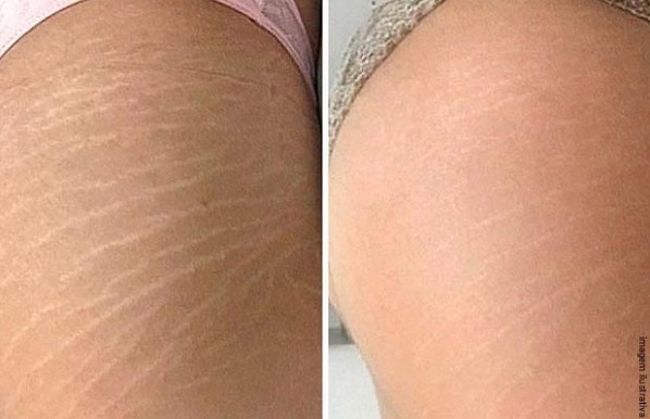 antes e depois de estrias na coxa antes e depois de estrias na coxa