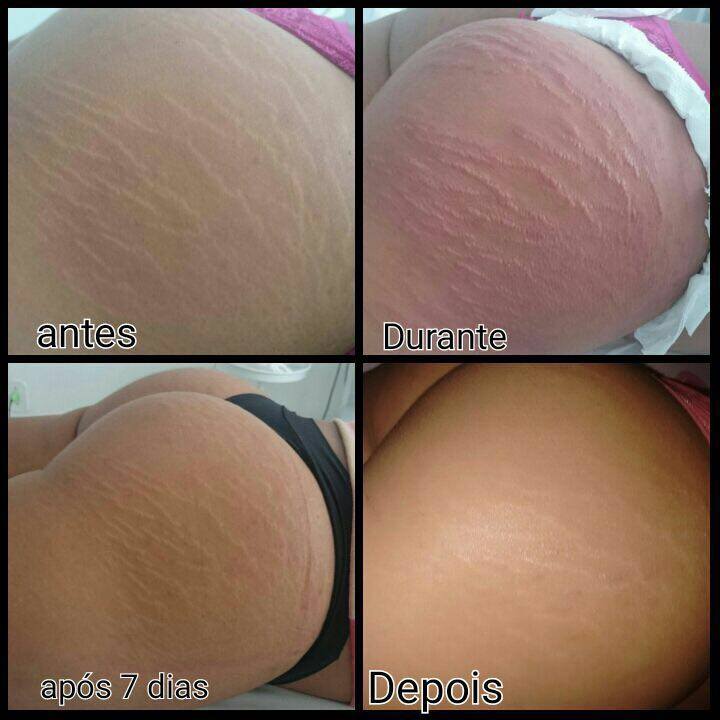 tratamento de estrias com técnica STRIORT tratamento de estrias com técnica STRIORT