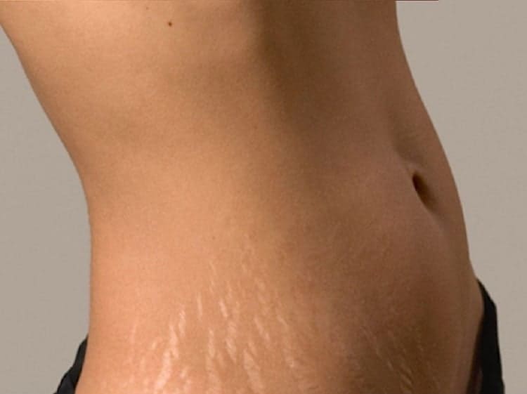 Estrias na barriga são muito comuns principalmente após a gravidez Estrias na barriga são muito comuns principalmente após a gravidez