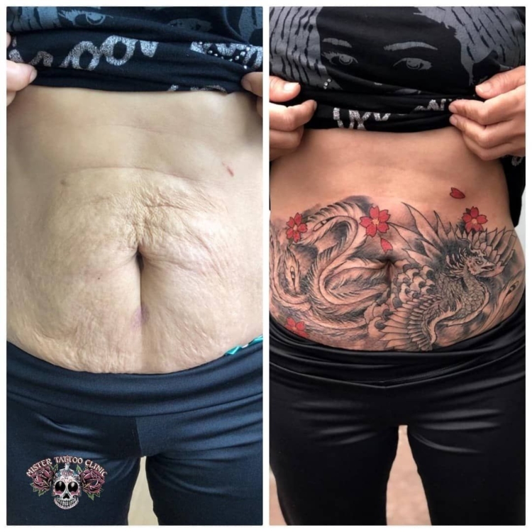 resultado tatuagem de desenho para esconder estrias resultado tatuagem de desenho para esconder estrias