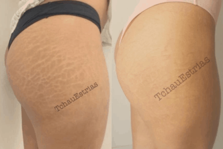 tratamento de estrias com dermaroller tratamento de estrias com dermaroller
