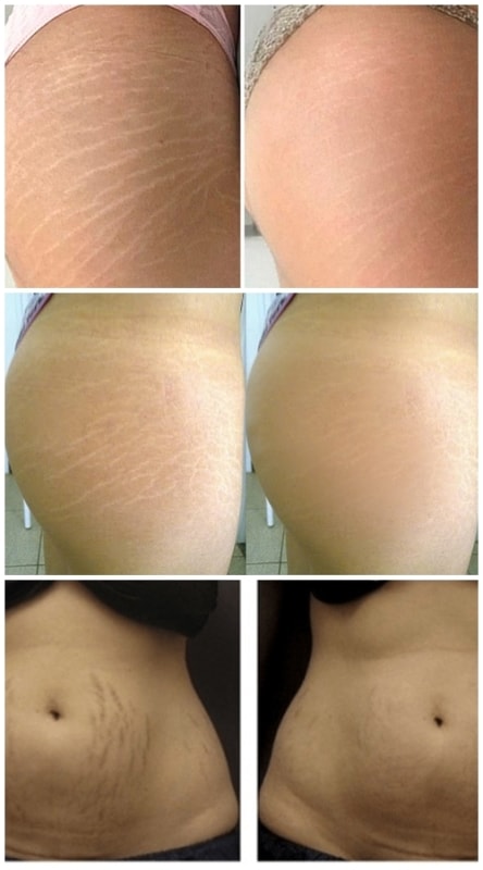 resultados antes e depois de peeling para estrias resultados antes e depois de peeling para estrias
