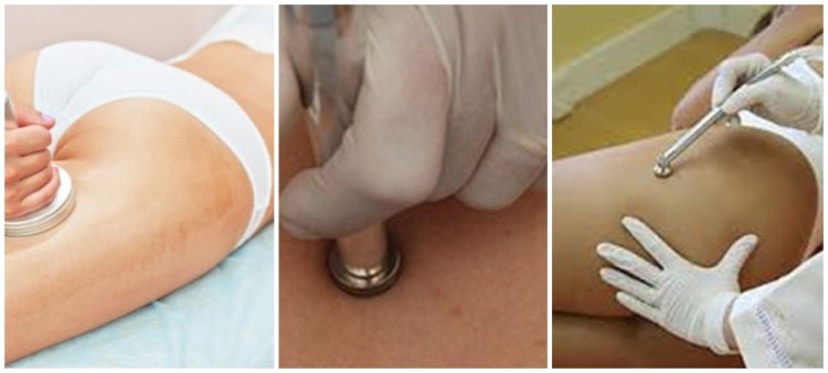 tratamento completar para peeling em estrias tratamento completar para peeling em estrias