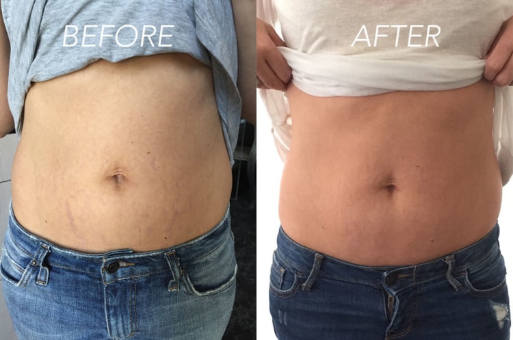 tratamento de estrias antes e depois tratamento de estrias antes e depois