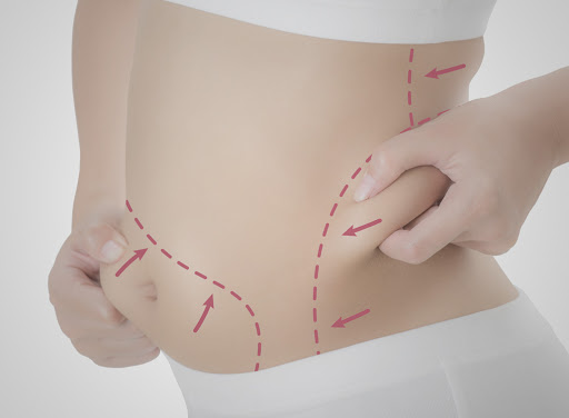 Abdominoplastia beneficios Abdominoplastia beneficios