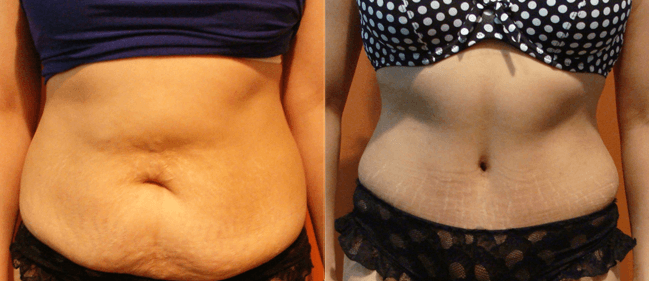 Abdominoplastia contra estrias Abdominoplastia contra estrias
