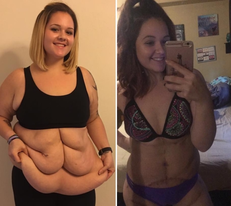 Abdominoplastia cuidados antes e depois Abdominoplastia cuidados antes e depois