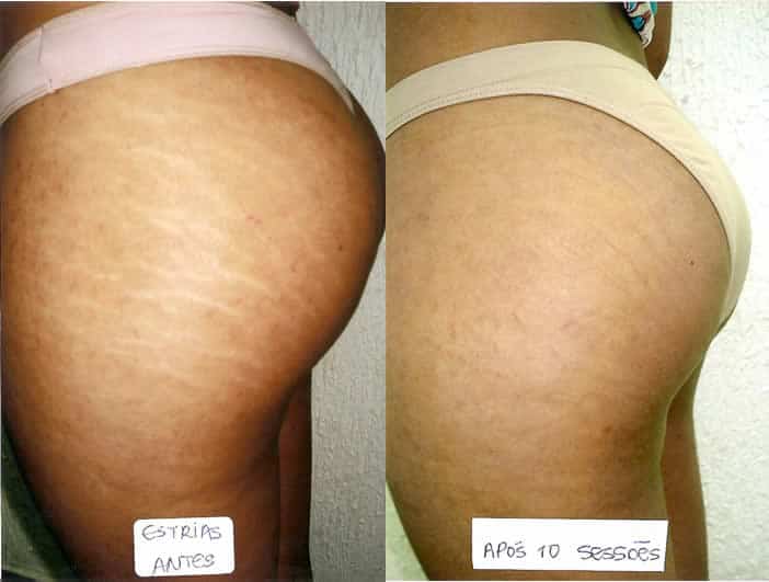 Antes e depois de dez sessões Antes e depois de dez sessões