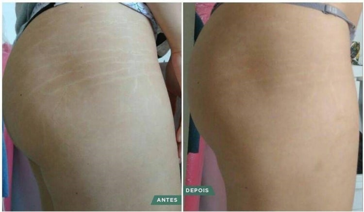 Antes e depois do tratamento para estrias Antes e depois do tratamento para estrias