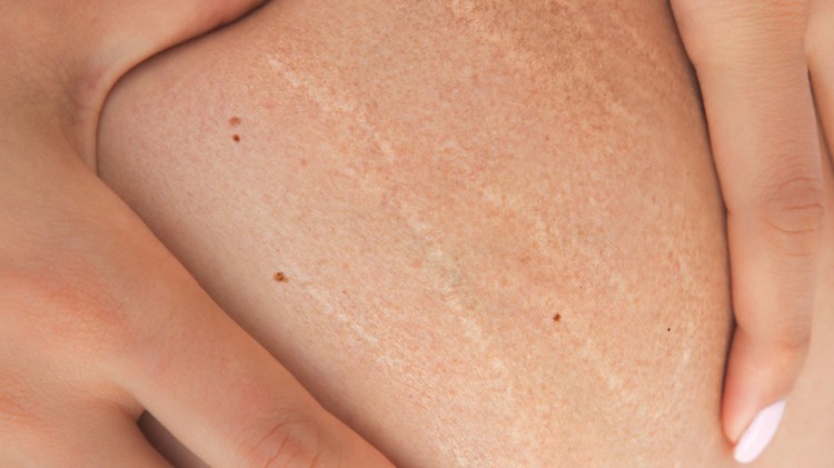 As estrias são inimigas mortais de muitas mulheres As estrias são inimigas mortais de muitas mulheres