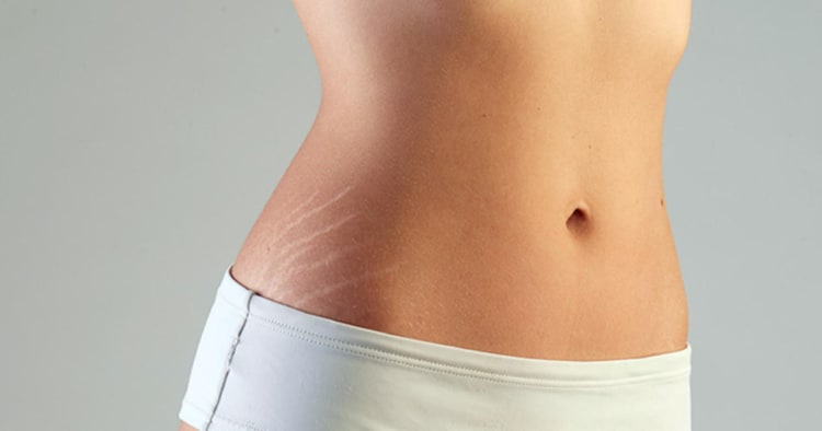 Estrias mais claras sinaliza que a estria está no corpo a mais tempo Estrias mais claras sinaliza que a estria está no corpo a mais tempo