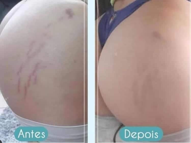 O tratamento para estrias pode ser um pouco demorado fatores como idade podem interferir no processo veja o antes e depois O tratamento para estrias pode ser um pouco demorado fatores como idade podem interferir no processo veja o antes e depois