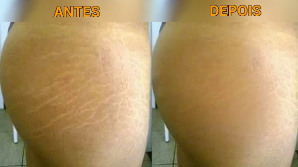 Resultado do tratamento para estrias Resultado do tratamento para estrias