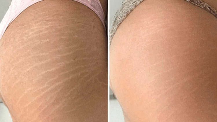 Tratamentos para estrias tem resultados positivos veja o antes e depois Tratamentos para estrias tem resultados positivos veja o antes e depois