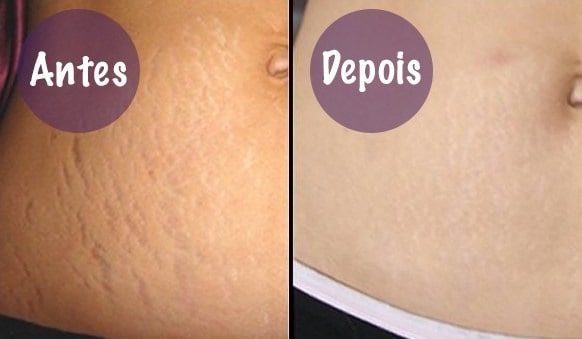 Tratamentos para estrias viraram uma tendência Tratamentos para estrias viraram uma tendência