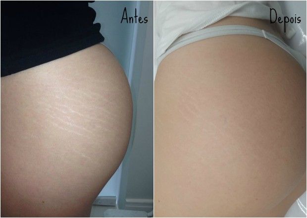 Veja o resultado do tratamento para estrias Veja o resultado do tratamento para estrias