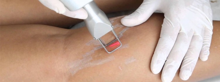 laser para estrias 1 laser para estrias 1