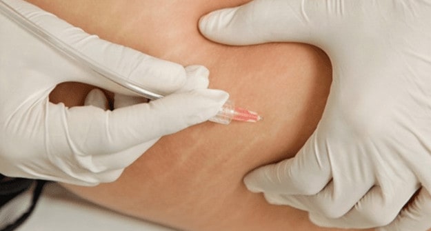 tratamento para estrias tratamento para estrias