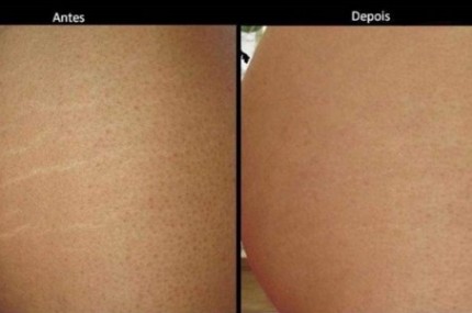 resultado do uso de vitanol a nas estrias resultado do uso de vitanol a nas estrias