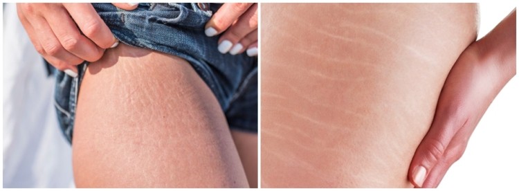 dicas para tratamento de estrias dicas para tratamento de estrias