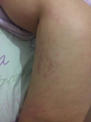 Estrias nas pernas aparecem por diversos fatores Estrias aparecem por diversos fatores