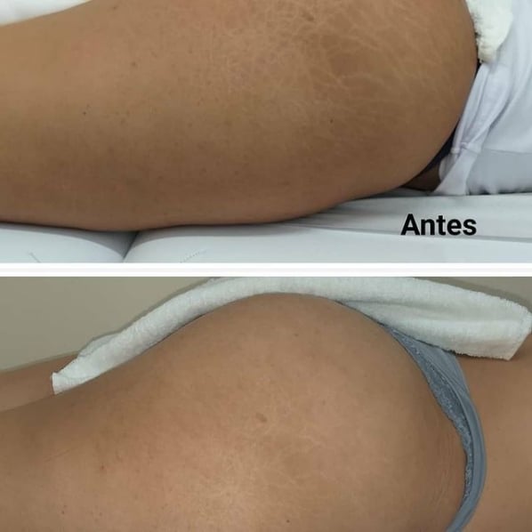 resultado de antes e depois de micropuntura