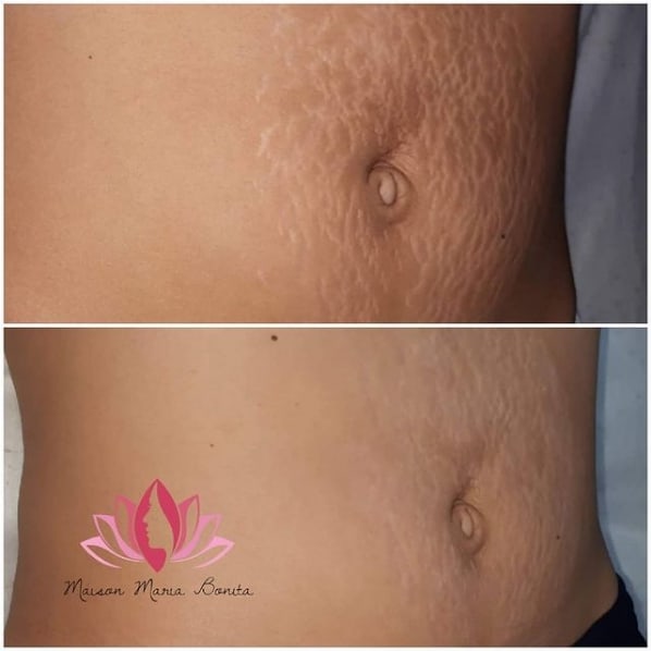 antes e depois de micropuntura na barriga