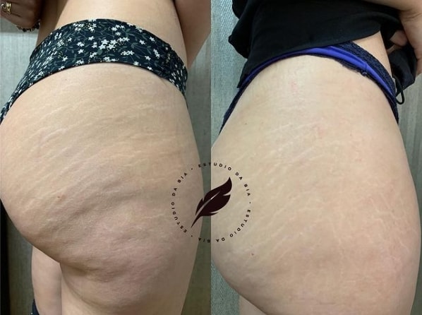 antes e depois de micropuntura no bumbum