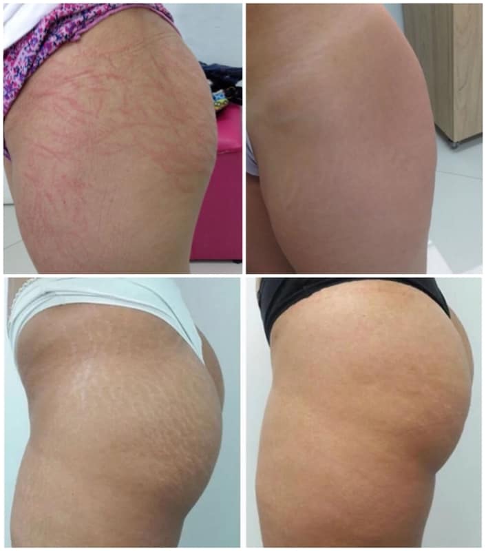 fotos de antes e depois de micropuntura para estrias